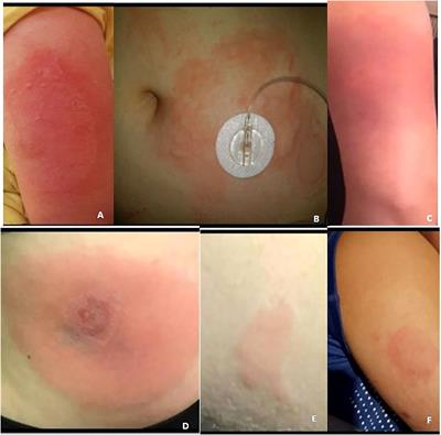 Case Report: Insulin hypersensitivity in youth with type 1 diabetes
